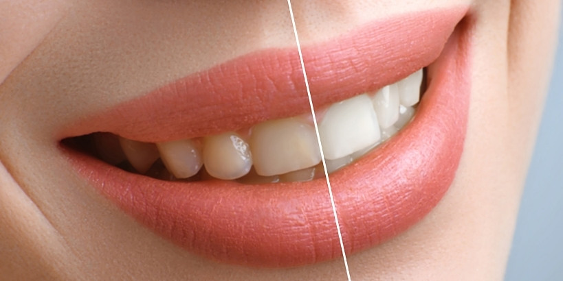 safe teeth whitening tips for sensitive teeth