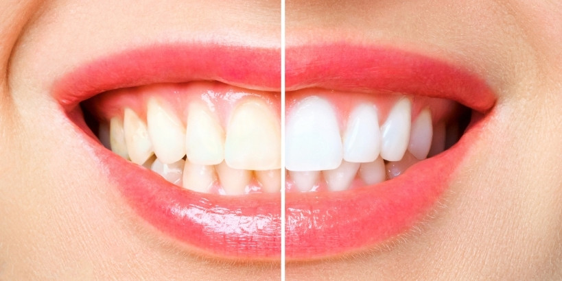 teeth whitening tips for a bright smile this christmas