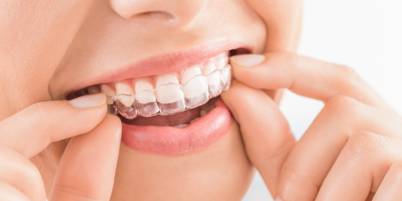 Common Invisalign Mistakes And How To Avoid Them?